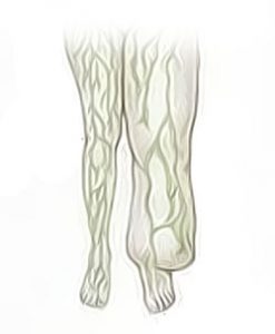lymphedema leg swelling